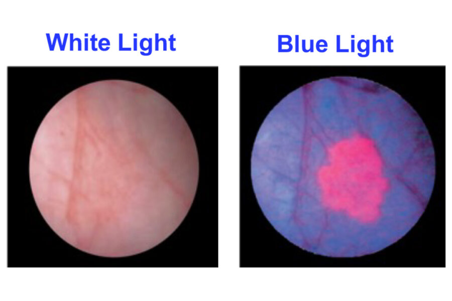 Bladder Cancer Blue Light Cystoscopy Imagin Medical