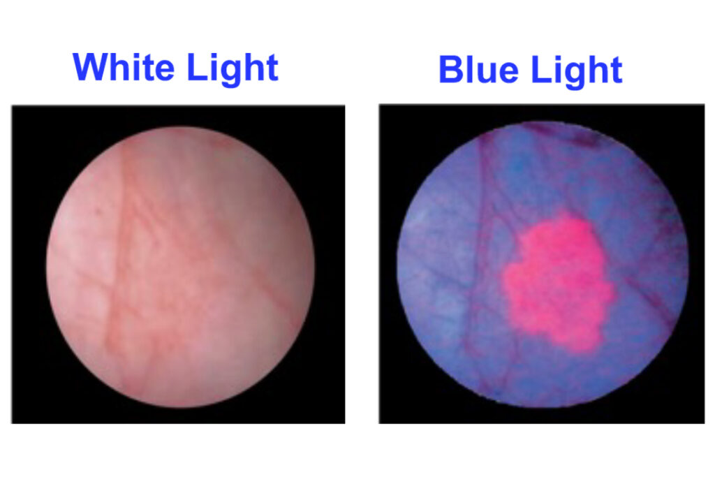 Bladder Cancer Blue Light Cystoscopy Imagin Medical 